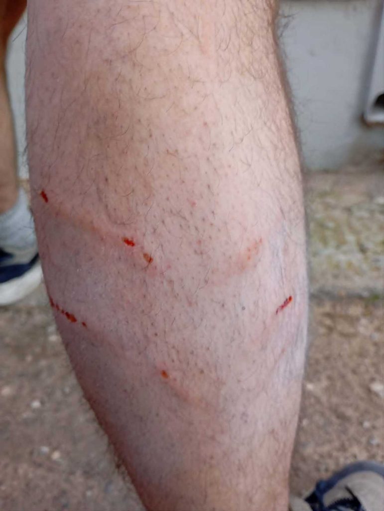 Ανθρώπινο πόδι με μικρές γρατζουνιές και αίμα από επίθεση αδέσπτοτων στο Άργος