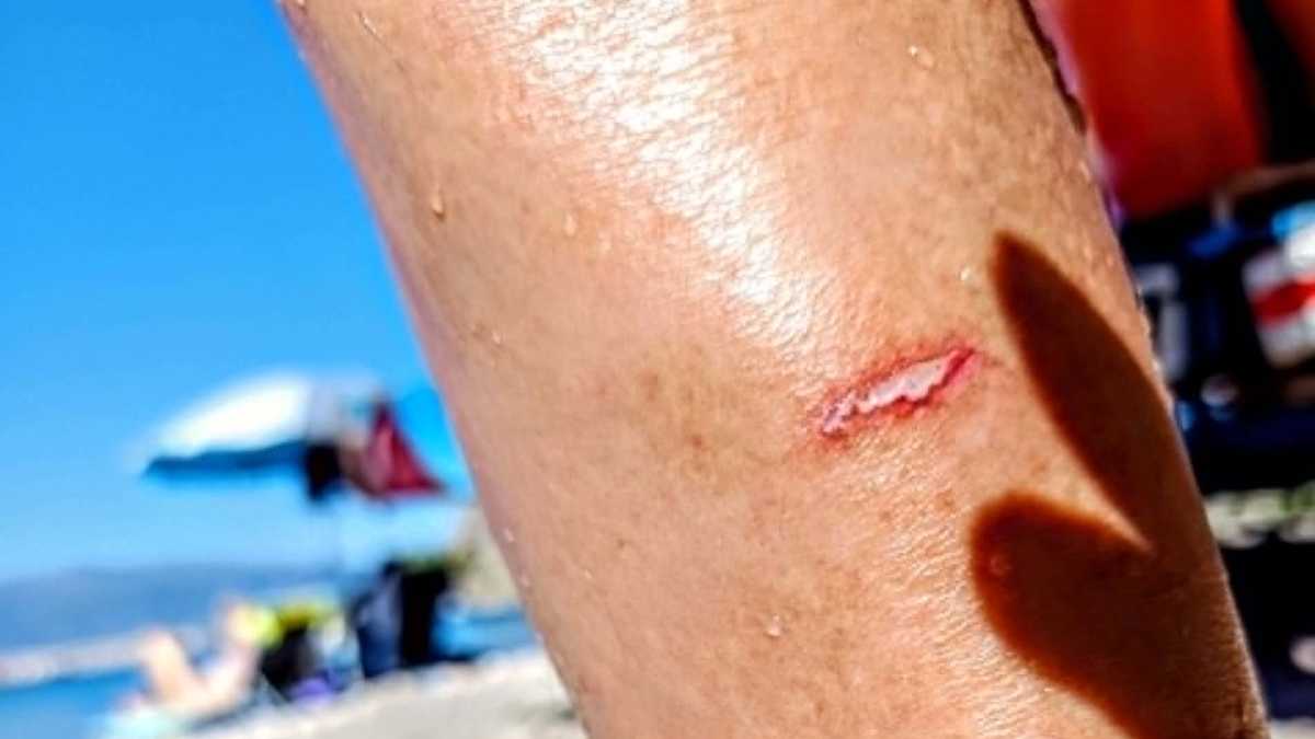 Καραθώνα: Δάγκωμα από ψάρι σε λουόμενο στα ρηχά